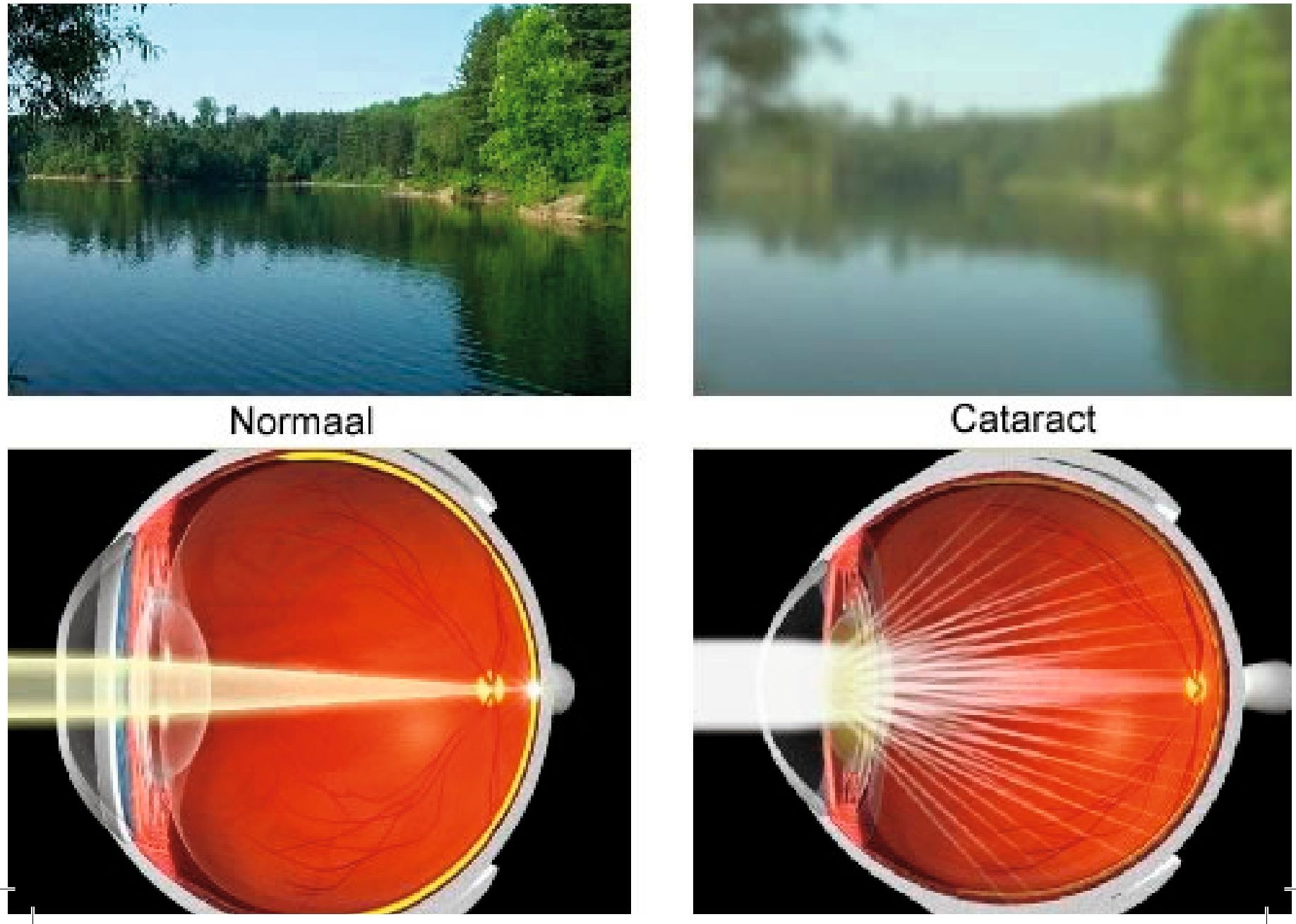 Vergelijking normaal zicht versus zicht bij cataract