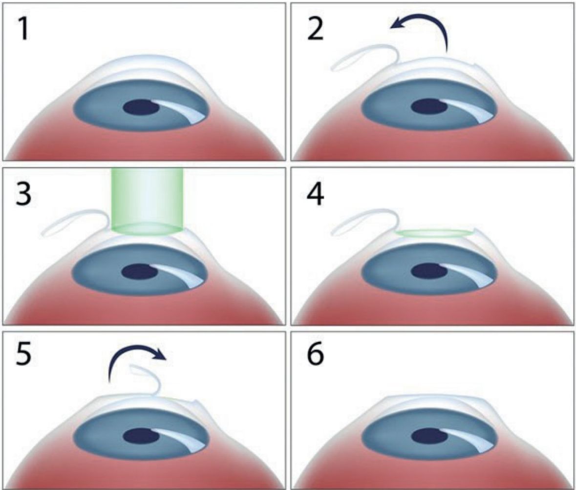 Stappen van de Femto-LASIK procedure: flap maken, laserbehandeling, terugplaatsen flap