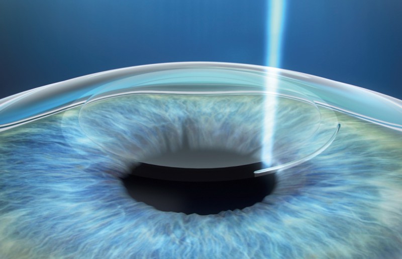 Ooglaser (refractieve chirurgie)